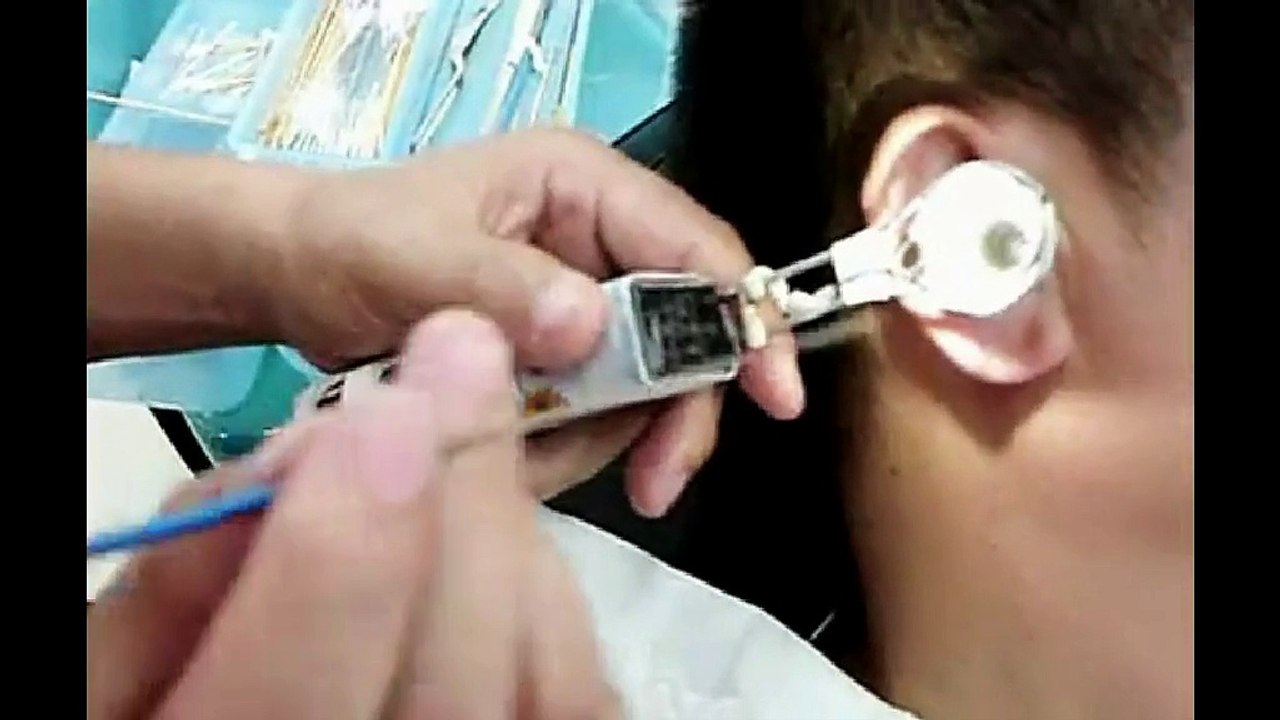 Chinese Ear Cleaning (104) DIY Using ear pick to clean out a large piece of ear wax