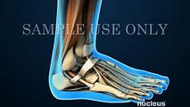 Arthroscopic Ankle Arthrodesis - Medical Video
