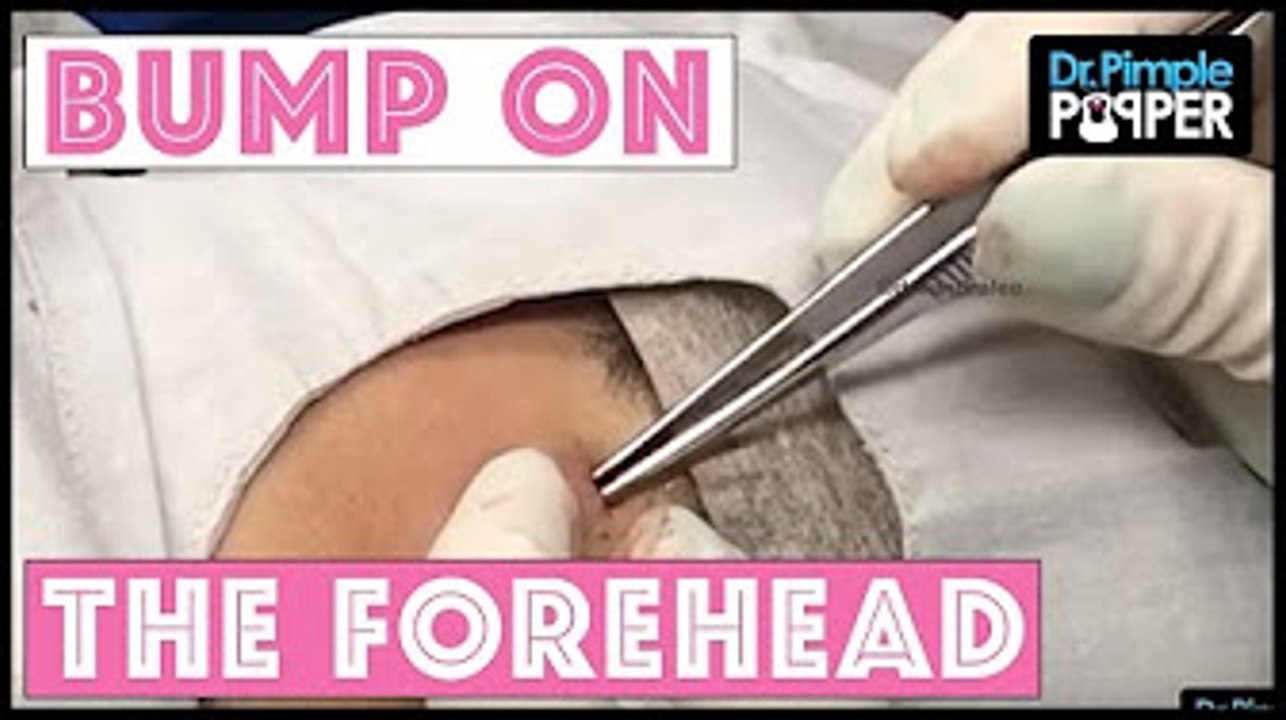 A Bluish Bump Squeezed on the Forehead - YouTube & Dr Sandra Lee