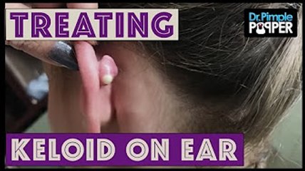 Watch a Cute Keloid Vanish with Cryoshape Treatment! ✨ | Dr. Sandra Lee