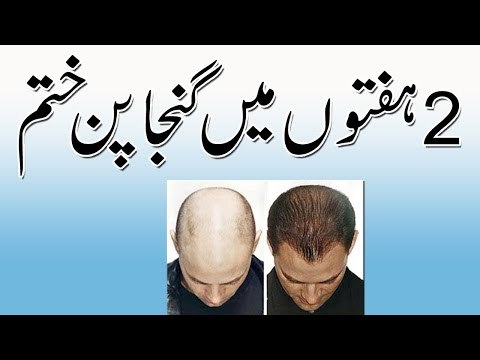 Balon ka Ilaj in Urdu - Bal Lamby Karny Ta Tarika - Hair Loss Treatment - Health and Beauty Tips
