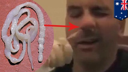 Man gets 5-foot-long tapeworm extracted from nose in horrifying video