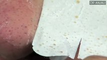 Nose Full Of Blackheads Blackheads Removal With Pore Strips