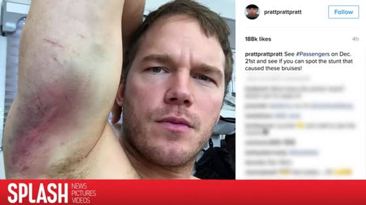 Chris Pratt Shows Terrible Bruises From 'Passengers' Stunts