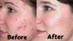 How to Get Rid of Acne Scars Overnight | Get Rid of Acne Scars Naturally At Home - Tips To Get Rid of Acne Scars