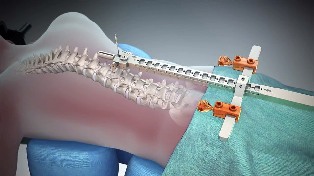 Robotic Assisted Spine Surgery Animation