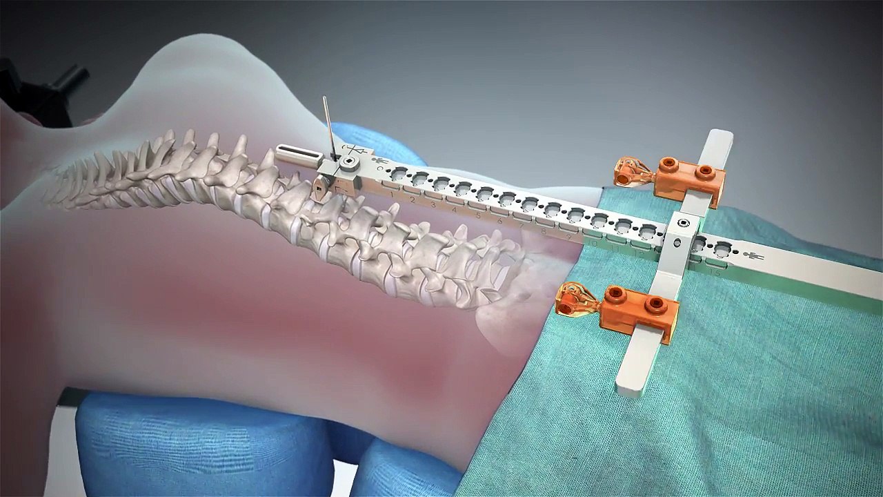 Robotic Assisted Spine Surgery Animation