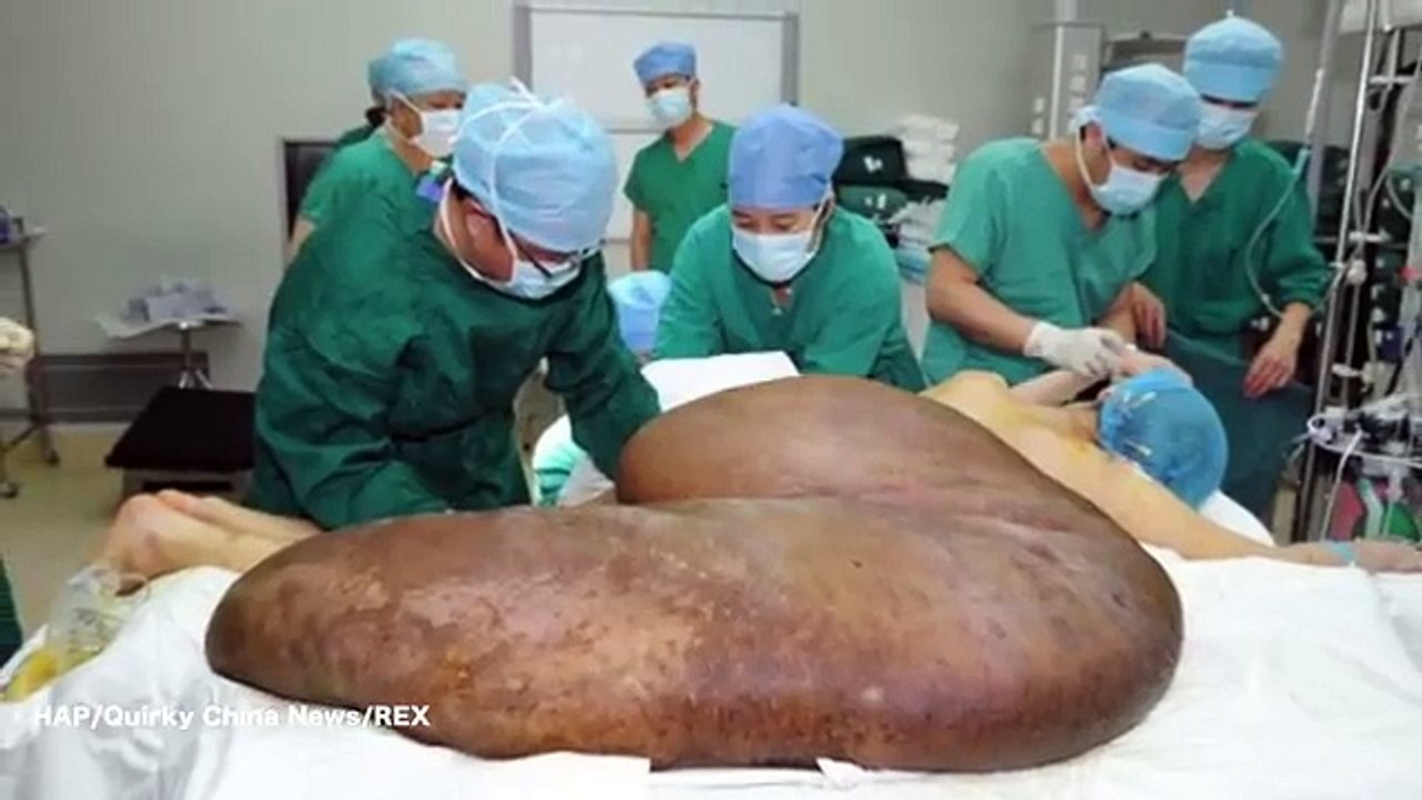 Surgeons Remove 240lb Tumor from Man's Back