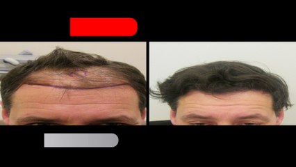 Hair Transplant 3000 Grafts - Op.Dr.Zekeriya KUL