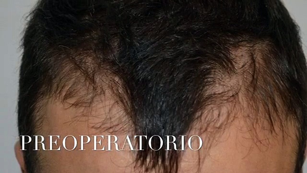 CLINICAS CETA CAPITAL www.injertodepelo.es