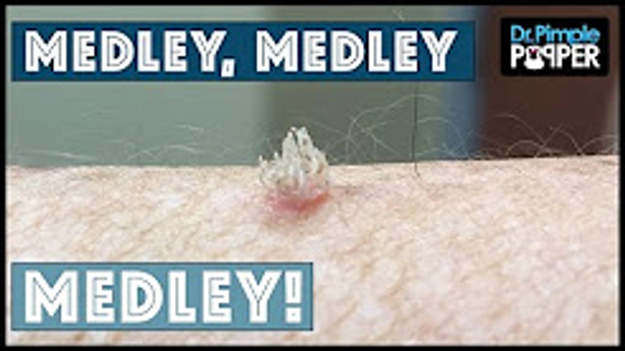A Dr Pimple Popper Medley! - YouTube & Dr Sandra Lee