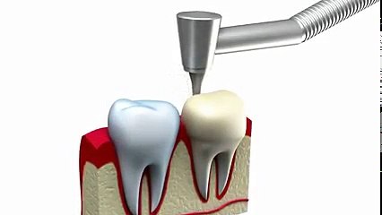 Crown - Dentistry at Park Place in Montgomery, AL