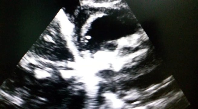 Mitral Valve Thrombosis On Echocardiography