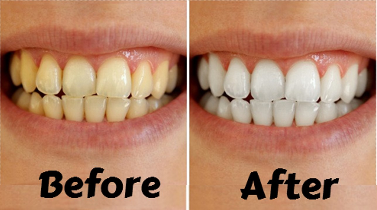 How To Whiten Teeth At Home | Tips To Whiten Teeth Naturally (Fast & Quickly)