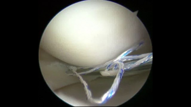 Nuevo tratamiento eficaz para curar las lesiones de menisco