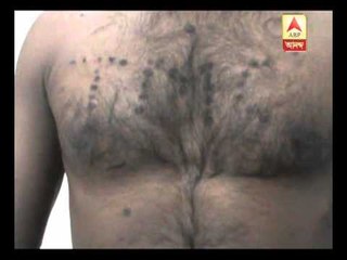 Hoogly BJP worker shows marks of injury from burning cigarette all over  upper portion of  his body.