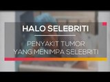Penyakit Tumor yang Menimpa Selebriti - Halo Selebriti