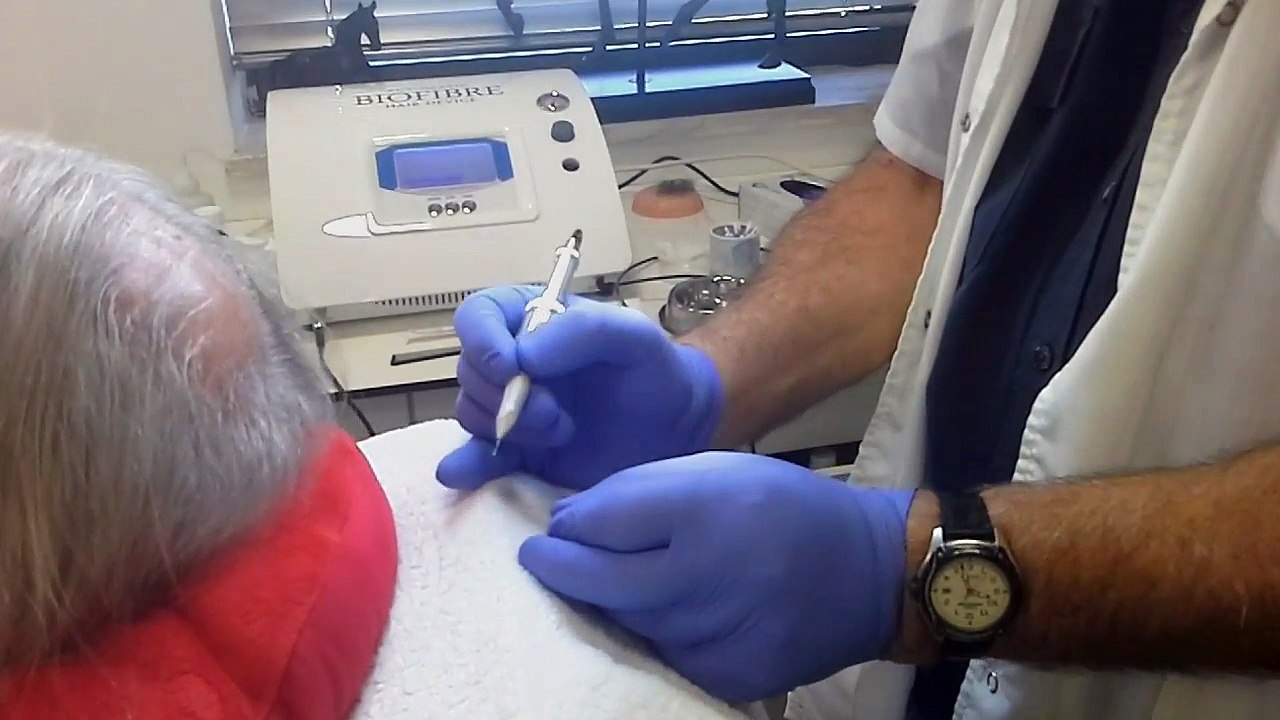 הדגמת השתלת שיער סינטטי - ד"ר יאיר גילוני