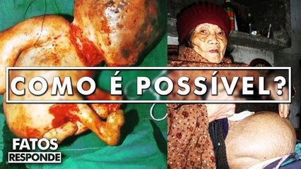 Como um feto pode se tornar múmia dentro da própria mãe