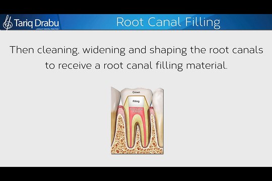 Root Canal Filling By Dr. Tariq Drabu