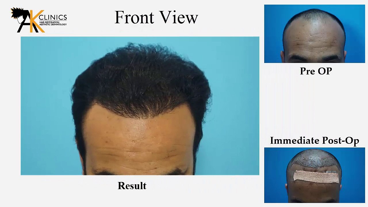 2000 Grafts FUE Hair Transplant Result after 8 Month by Dr Kapil Dua, India