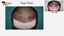 1400 Grafts FUE Hair Transplant Surgery Result After 8 Month - Delhi, India