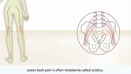Vancouver Spine & Disc Centre Reveals What is Sciatica