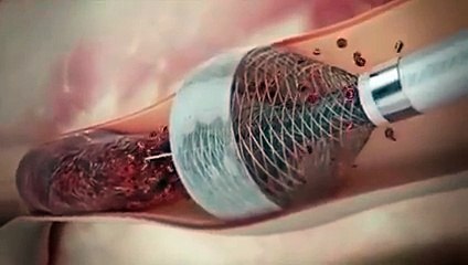 How to Remove Heart Blockage Without Surgery