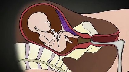 2nd Trimester Abortion Procedure _ Dr. Anthony Levatino - Former Abortionist Turns Pro-Life