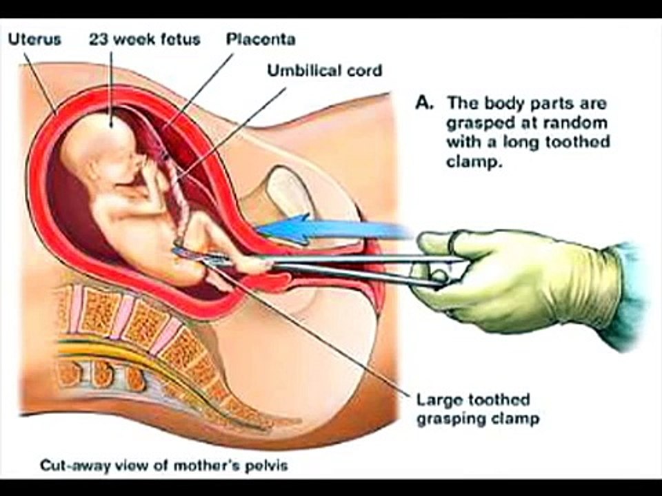 Abortion animated video