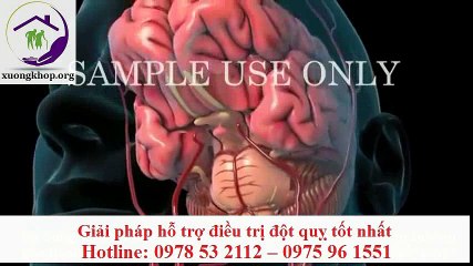 Tai biến mạch máu não xảy ra như thế nào