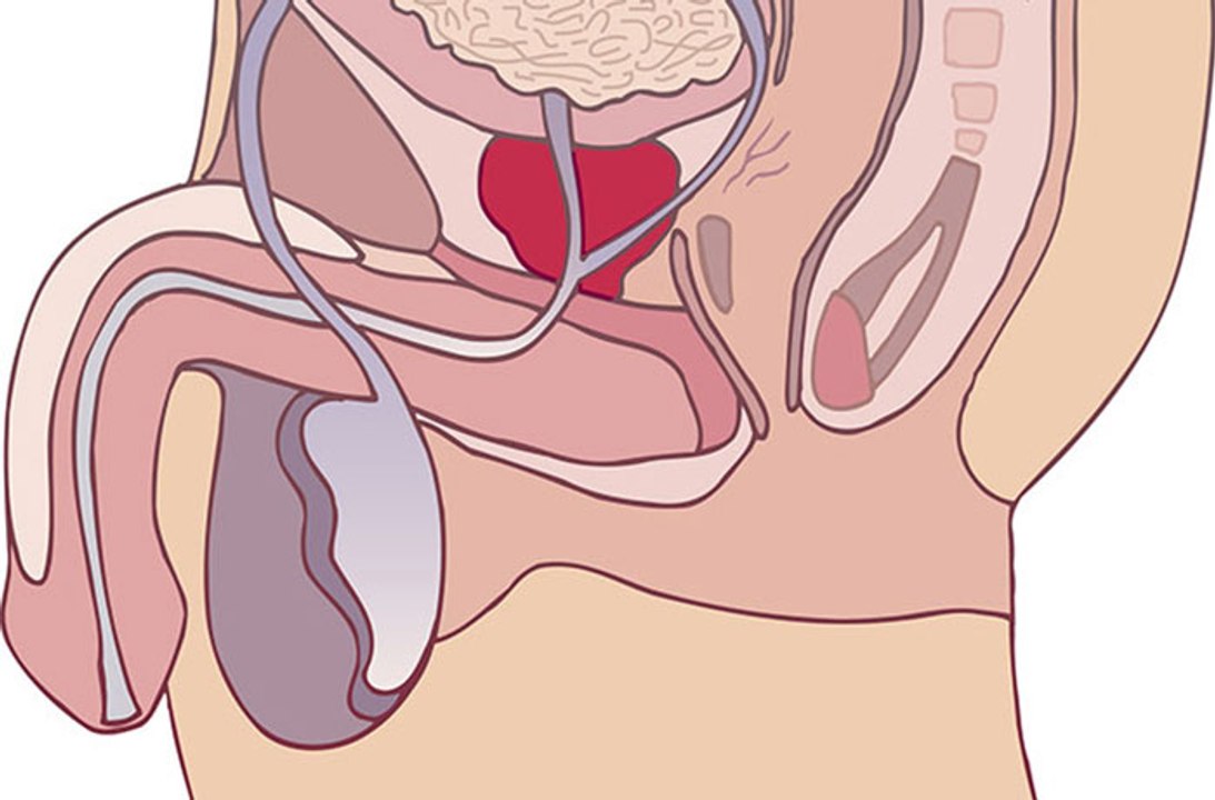 Benign Prostatic Hyperplasia (BPH) Symptoms
