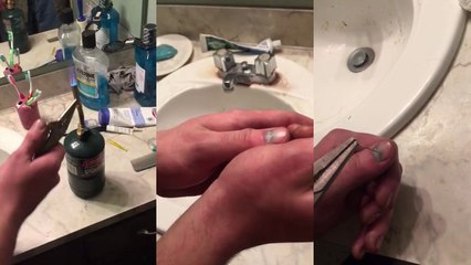 Percer un hématome sous l'ongle