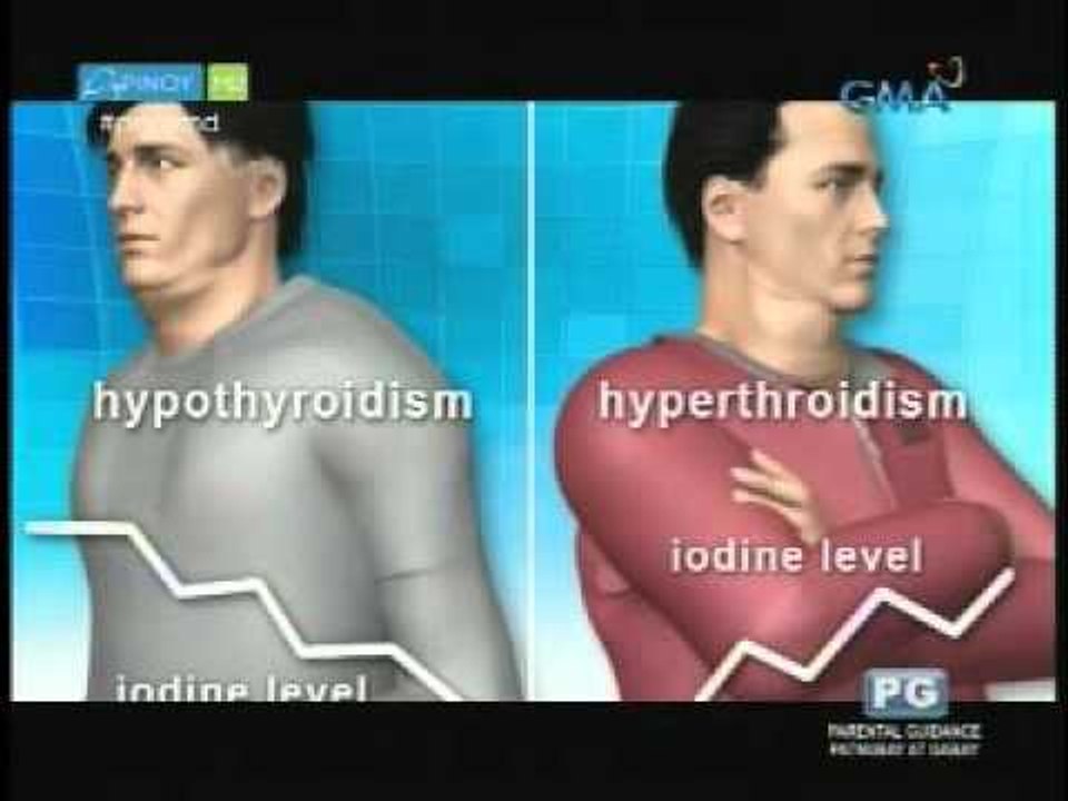 Tips para maiwasan ang pagkakaroon ng goiter |...
