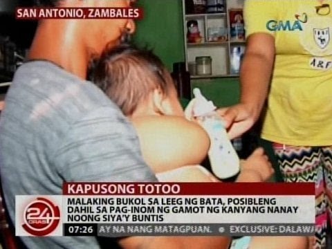 Malaking bukol sa leeg ng bata, posibleng dahil sa pag-inom ng gamot ng kanyang nanay noong buntis