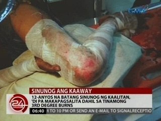 12-anyos na batang sinunog ng kaalitan, 'di pa makapagsalita dahil sa tinamong 3rd degree burns
