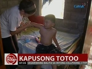 24 Oras: 7-anyos na bata, pinahihirapan ng pambihirang sakit na cystic hygroma