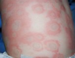 Fungal Infections of the Skin: Ringworm