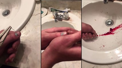 Il se perce un hématome sous l'ongle