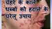 Pimple and acne tips in Hindi – चेहरे के काले धब्बों को हटाने के घरेलू उपाय