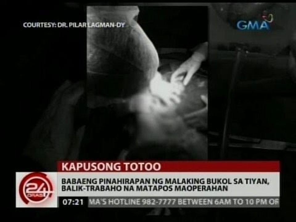 24 Oras: Babaeng pinahirapan ng malaking bukol sa tiyan, balik-trabaho na matapos maoperahan