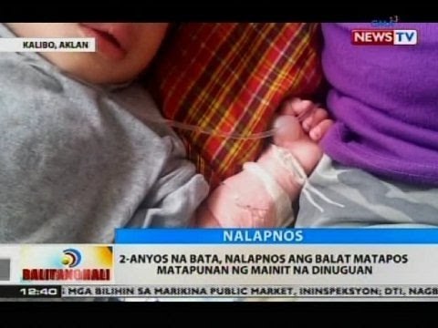 BT: 2-anyos na bata, nalapnos ang balat matapos matapunan ng mainit na dinuguan