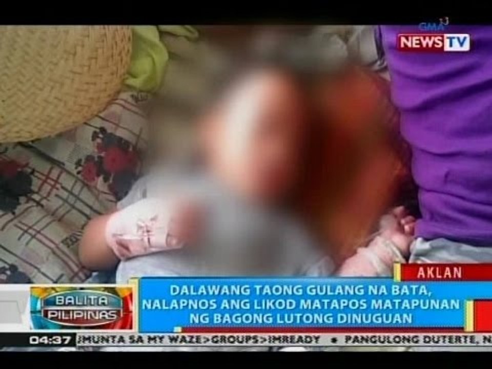 2 taong gulang na bata, nalapnos ang likod matapos matapunan ng bagong lutong dinuguan