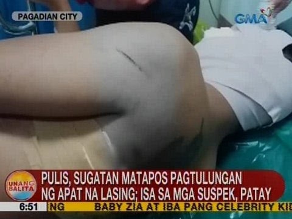UB: Pulis, sugatan matapos pagtulungan ng 4 na lasing sa Pagadian City