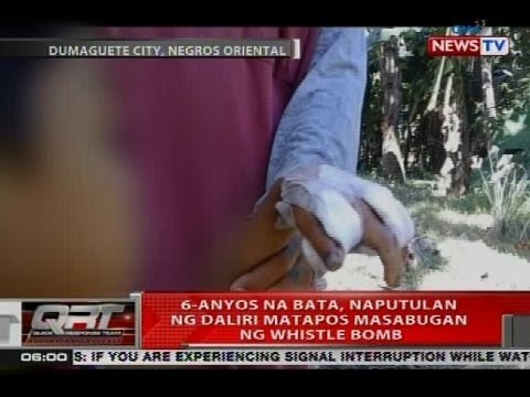 6-anyos na bata, naputulan ng daliri matapos masabugan ng whistle bomb