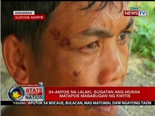 SONA: Mga nabibiktima ng paputok ngayong taon, umabot na sa 70