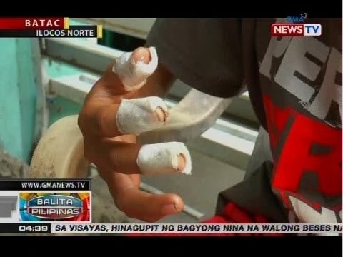 BP: 14-anyos na binatilyo, nalapnos ang daliri matapos masabugan ng piccolo