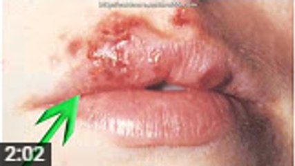 How to Get Rid of Fever Blisters Overnight