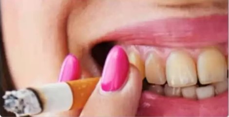 How To Remove Tobacco Stains From Teeth