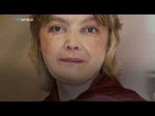 The world's 1st facial transplant recipient has died
